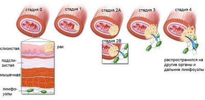 инфекция