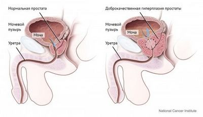 рака простаты