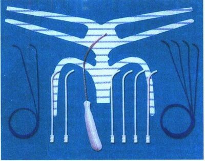 криоабляция криоабляция