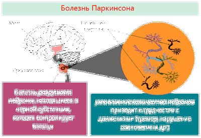 паркинсона