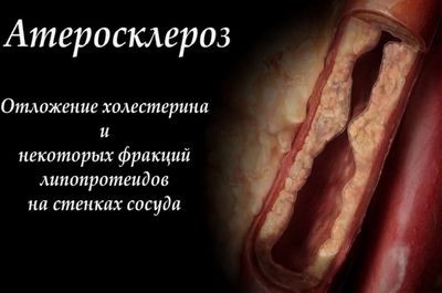 атеросклероз